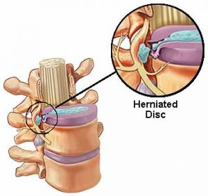 Herniated Disc