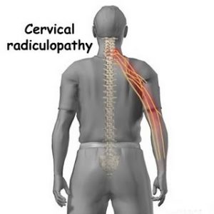 Radiculopathy